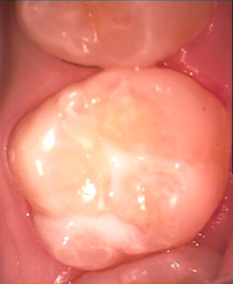 Fissurenversiegelter Zahn nach Kariessterilisation mit Ozon